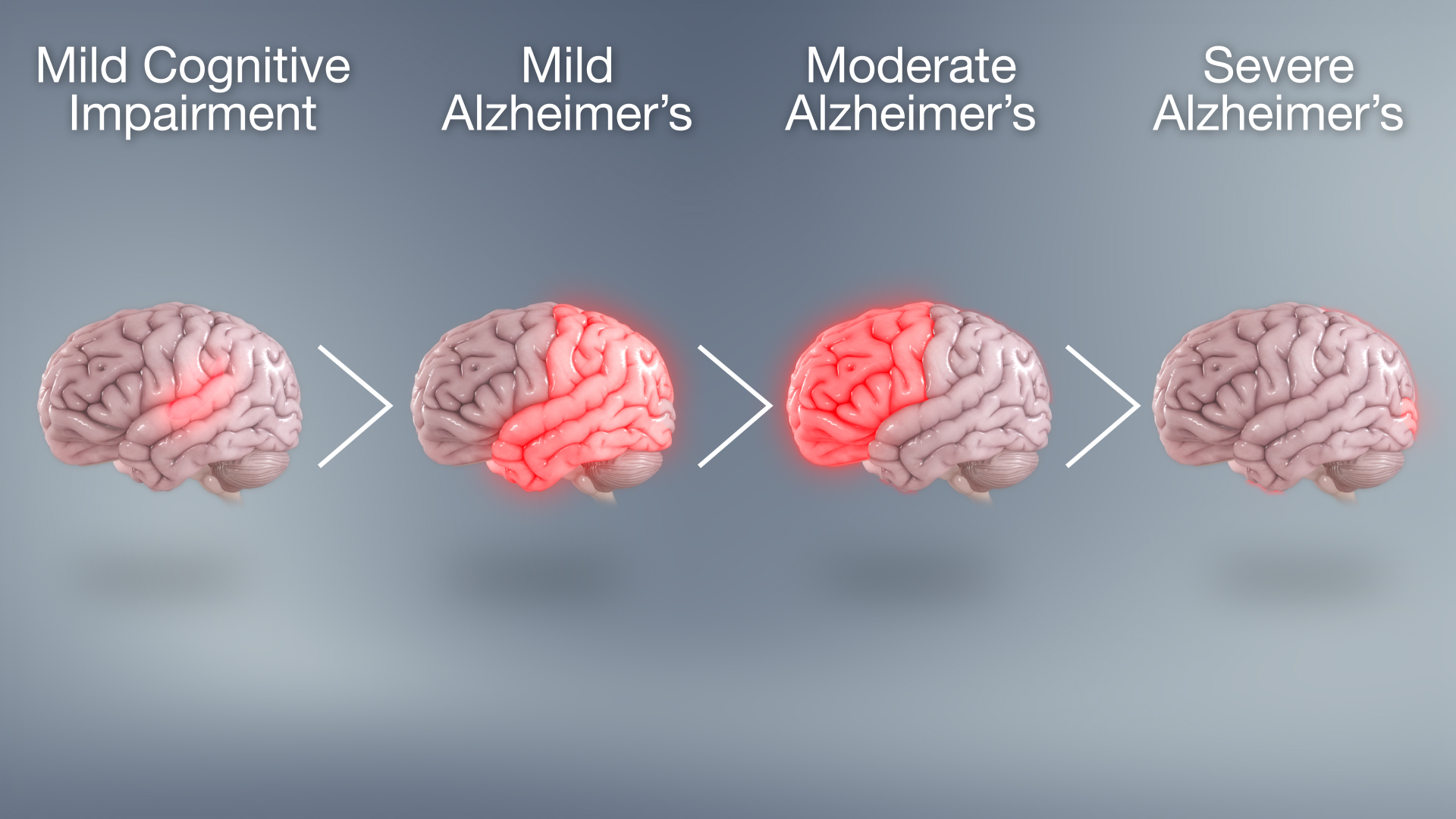 alzheimer dementia stages