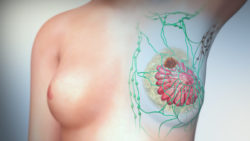 3D Medical Animation still showing Breast Cancer