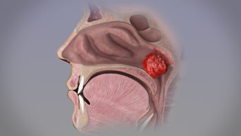 Adenoid Hypertrophy