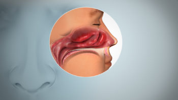 Inflammed nasal mucosa causing anosmia