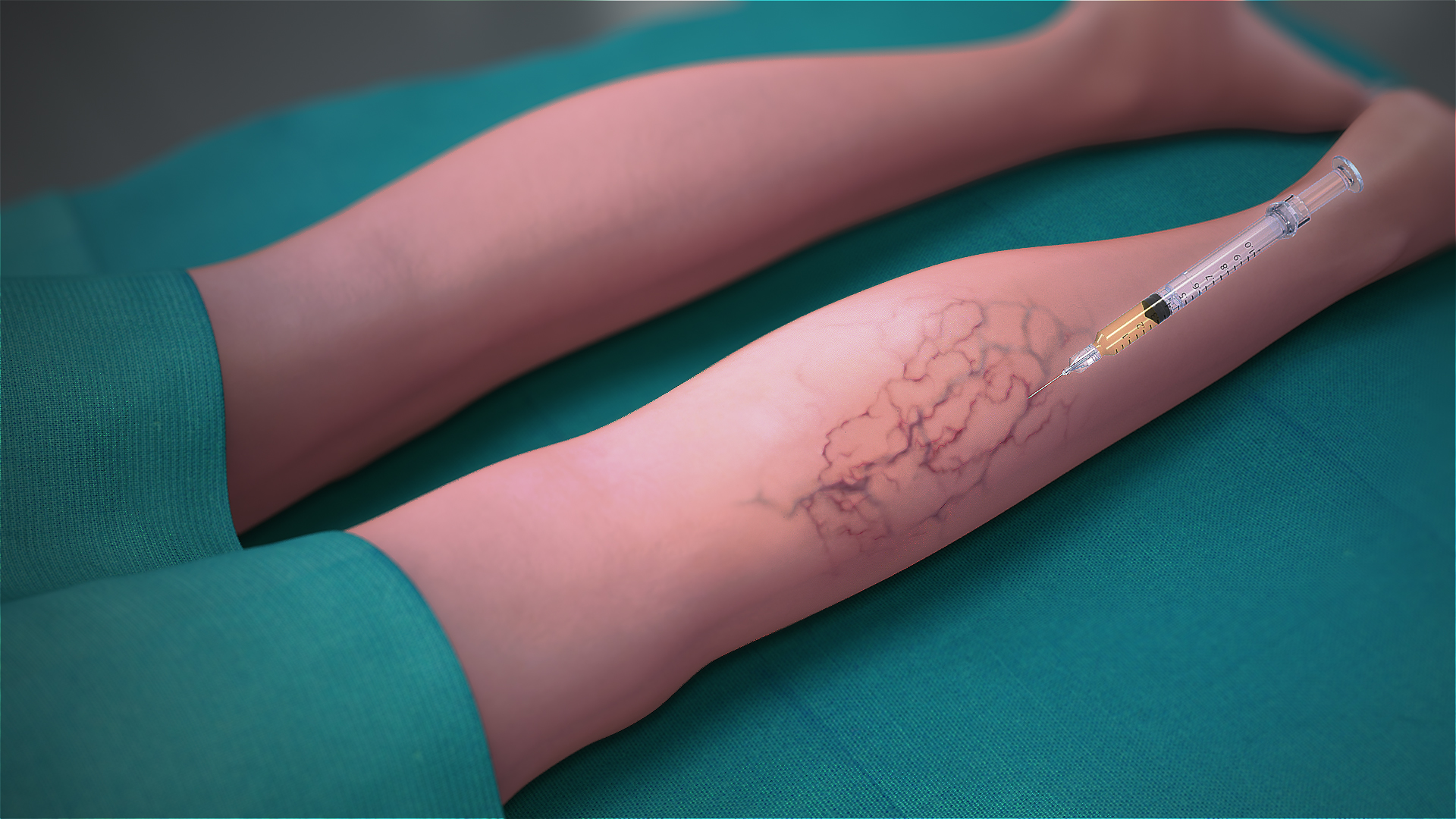 Treating Varicose Veins Focus On Sclerotherapy Scientific Animations