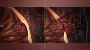 Benign (L) vs Malignant tumor (R)