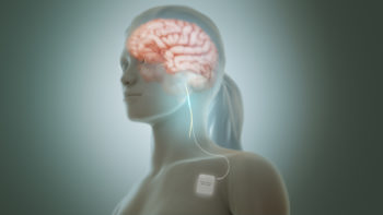 Vagus nerve stimulation