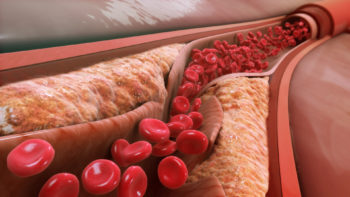 Narrowed arterial blood vessel.