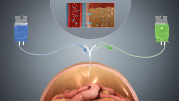 A depiction of Peritoneal dialysis in case of kidney failure.