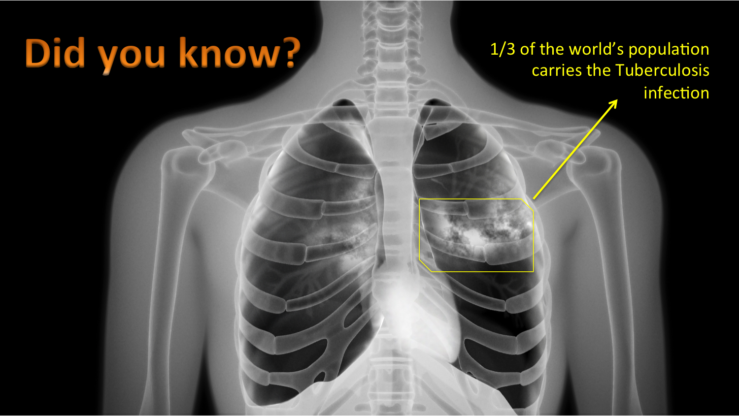 A lab-designed sugar molecule may revolutionize Tuberculosis diagnosis