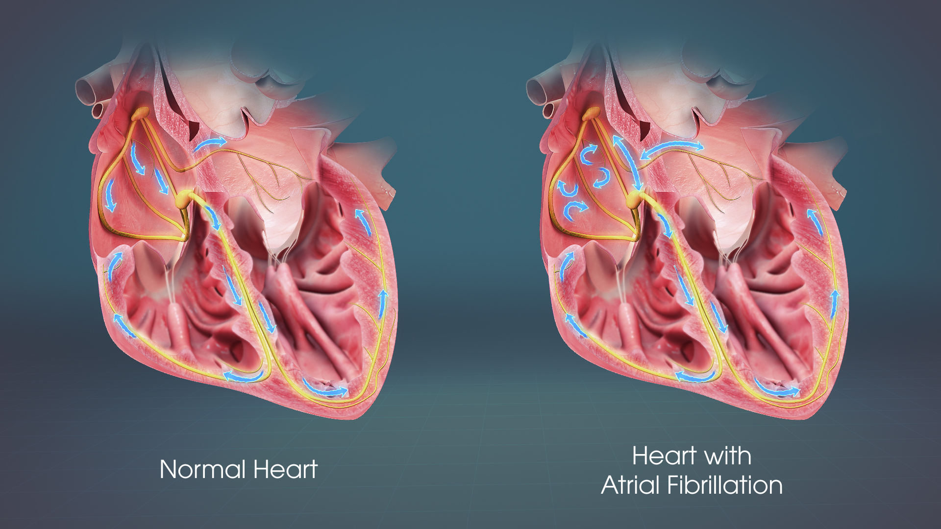 Atrial Fibrillation & Related Cardiac Risks 
