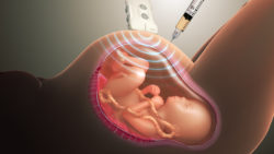3D Medical Animation still showing Amniocentesis