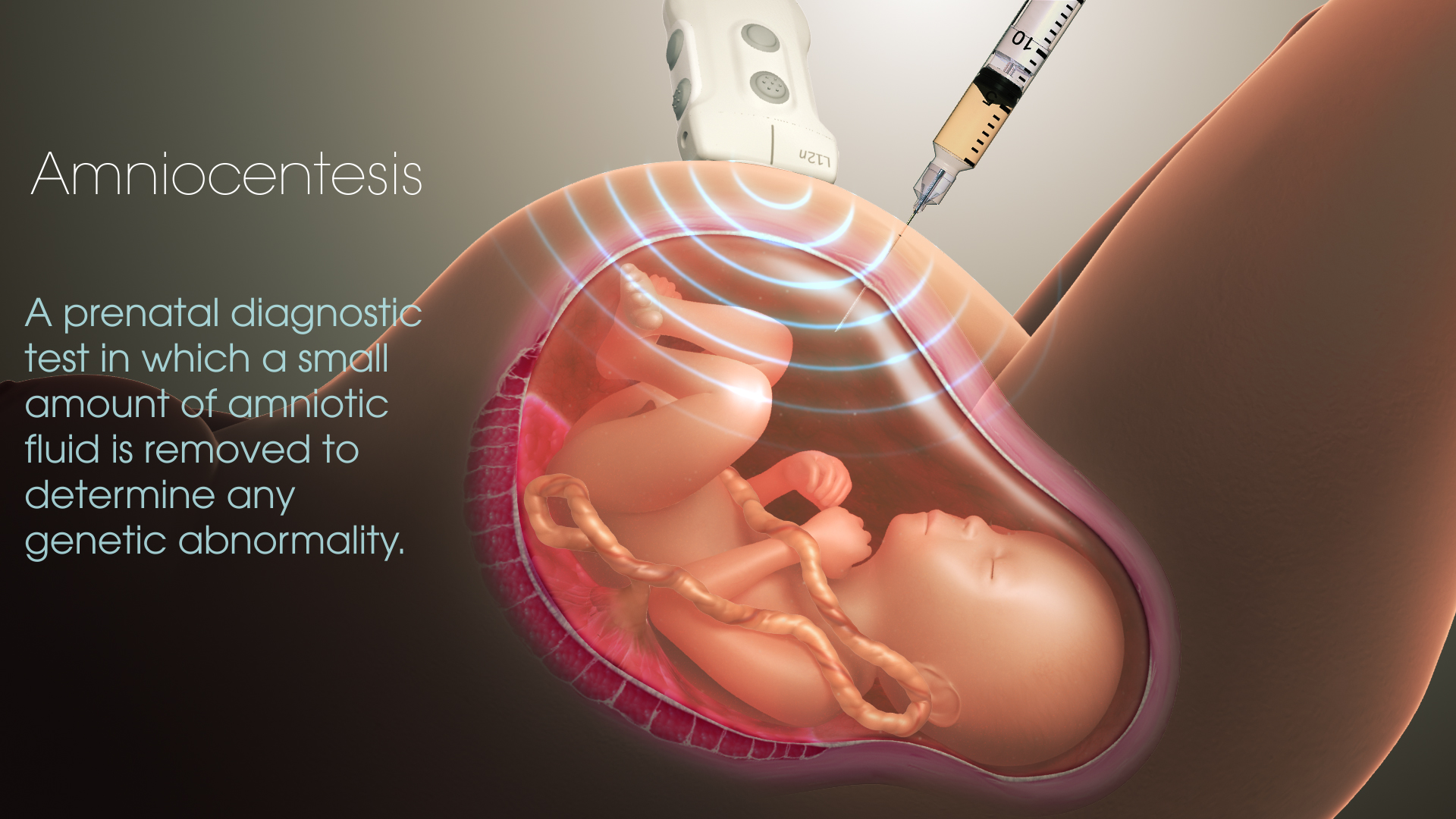 What is an Amniocentesis? - Scientific Animations