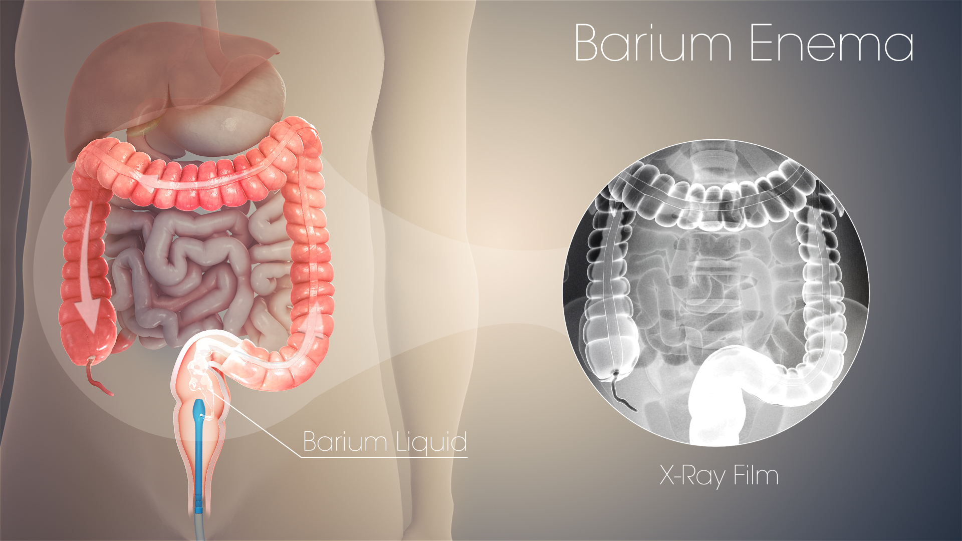 Barium Enema: Fluoroscopic X-ray of the Lower GI Tract