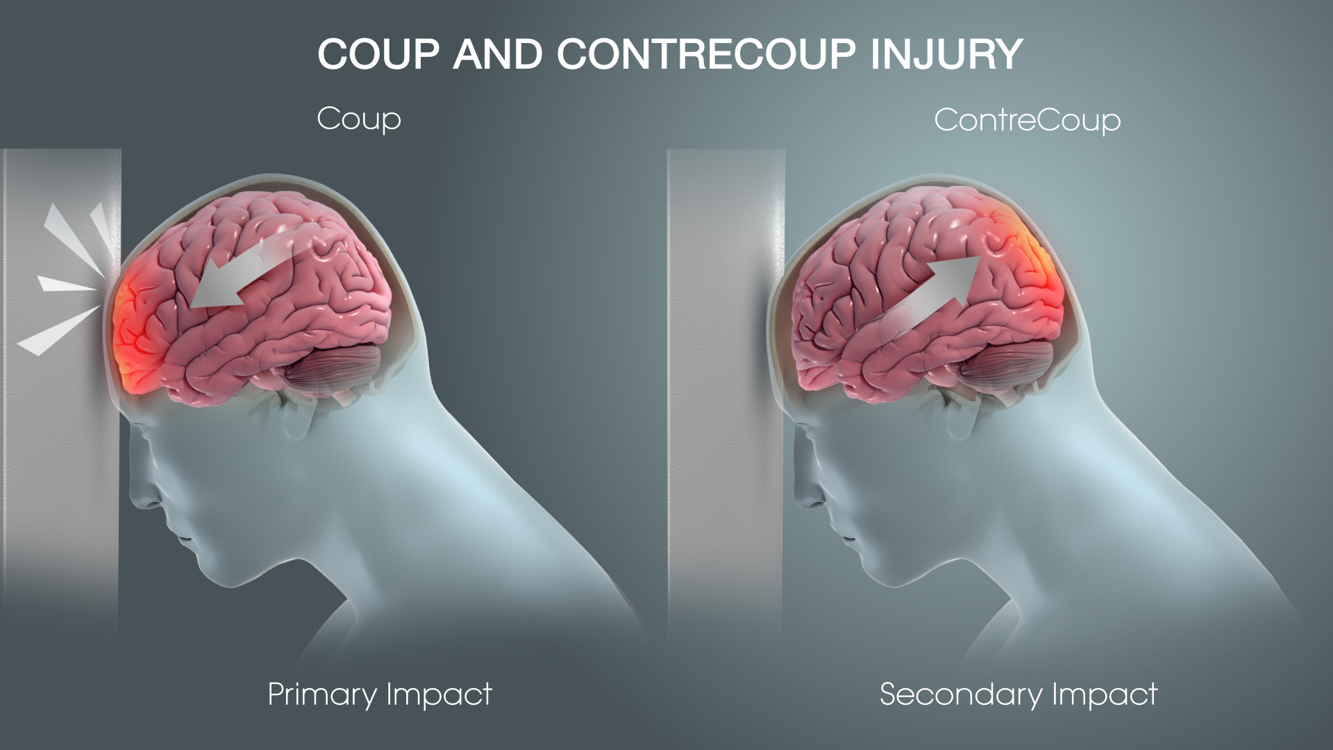 Understanding Hematomas and Traumatic Brain Injury 