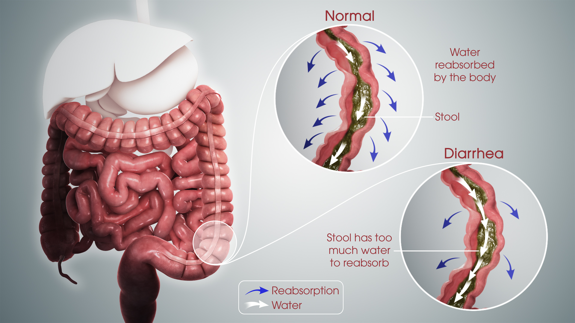 Pathophysiology Of Diarrhoea In Flow Chart