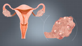 Polycystic Ovaries