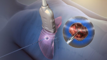 Radiofrequency ablation