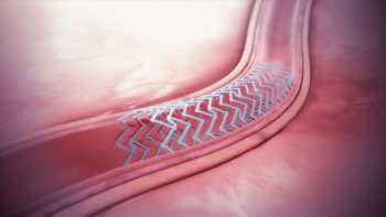 Bioresorbable stent