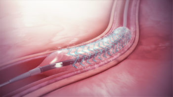 Drug-eluting stent