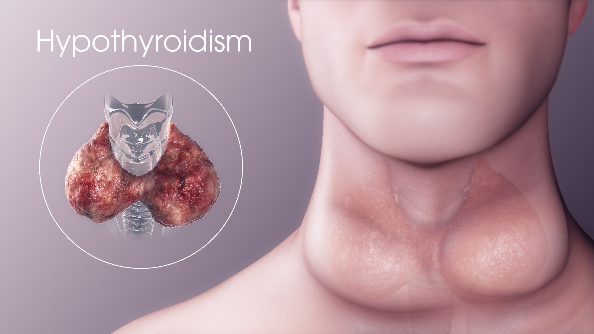 3D Medical Illustration - Hypothyroidism