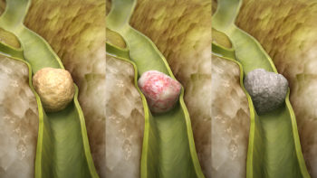 From LtoR: Cholesterol stone, Mixed stone, Pigment stone.