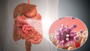 Gastroenteritis caused due to intestinal infection.