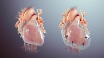 A healthy heart covered with pericardial membrane (L) and, Inflammed pericardium with pericardial fluid compressing the cardiac muscle (R).