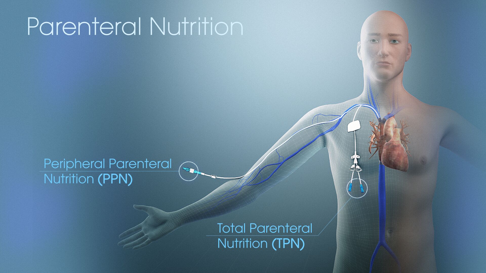 case study on parenteral nutrition