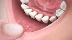 3D medical animation still showing Canker Sores