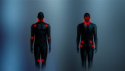 3D Medical Animation still showing Fibromyalgia Trigger points