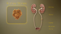 3D Medical Animation still - Kidney Stones