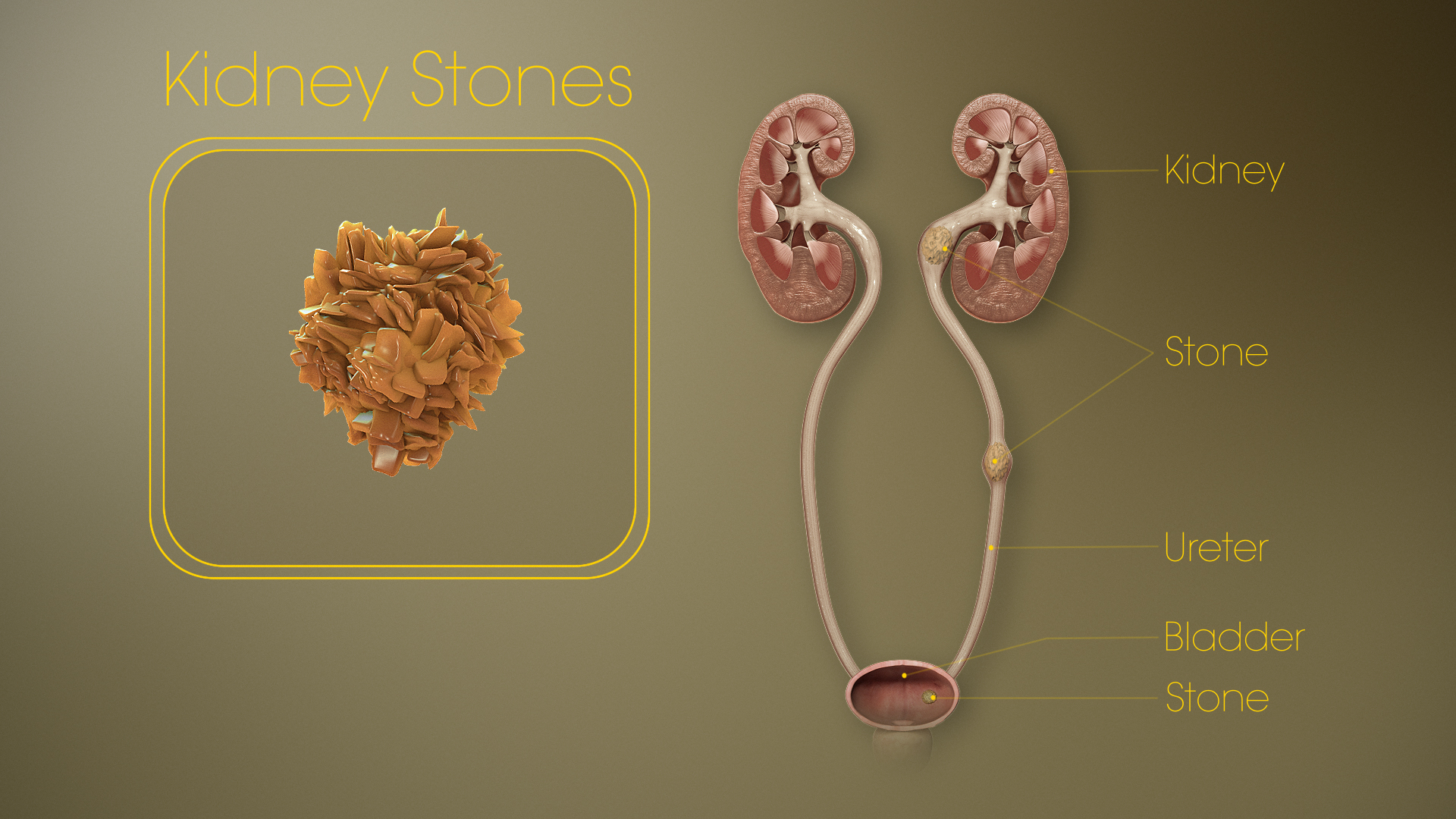 Kidney stones: Causes, Symptoms, Treatment and Medication