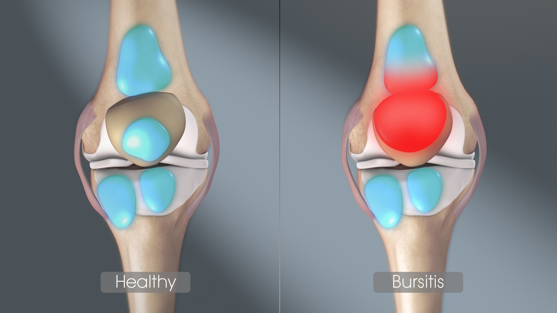 3D medical animation still showing inflammation of bursae in a Bursitis affected joint