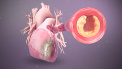 3D medical animation showing plaque buildup in a coronary artery compromising the blood flow to it.