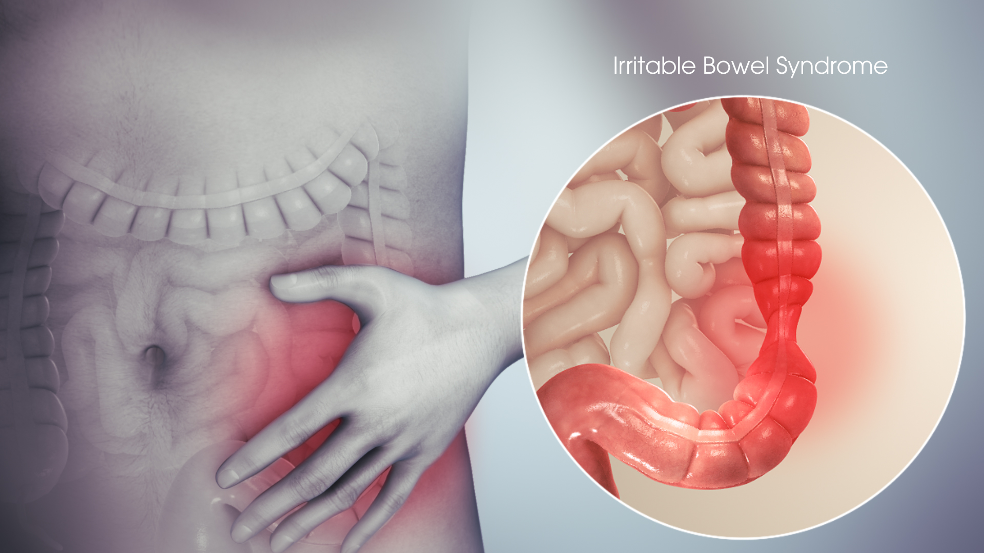 3D Medical Animation showing Irritable Bowel Syndrome