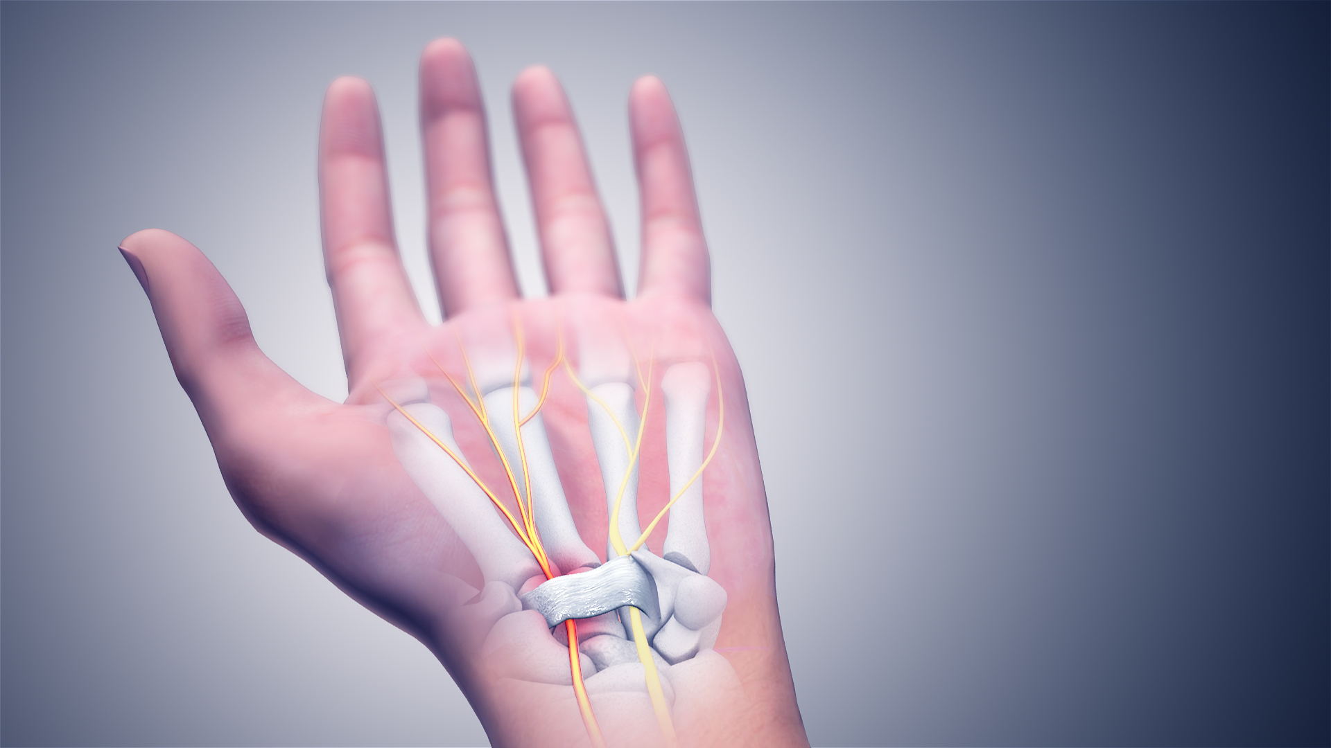 3D Medical Animation still of Carpal Tunnel Syndrome at the carpal tunnel