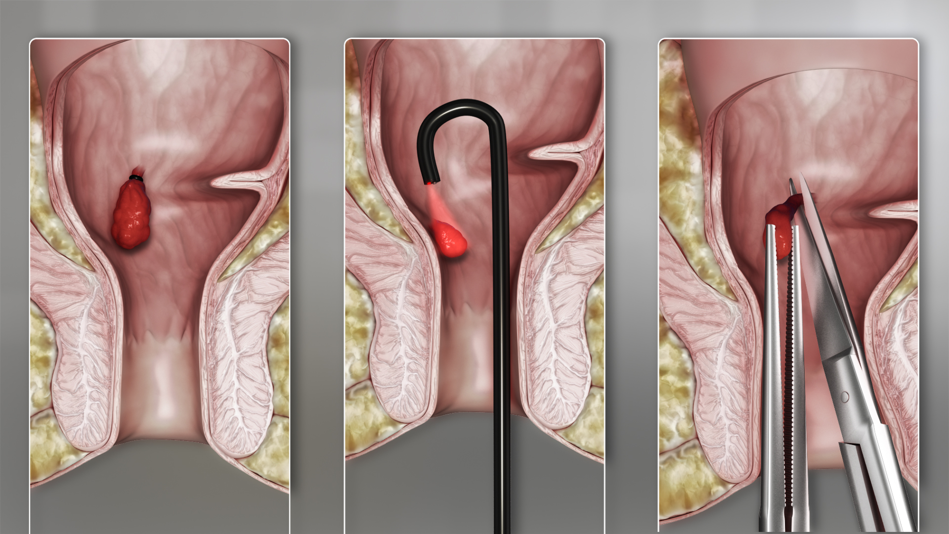 Hemorrhoids: Types, Causes, and Treatments - Scientific Animations