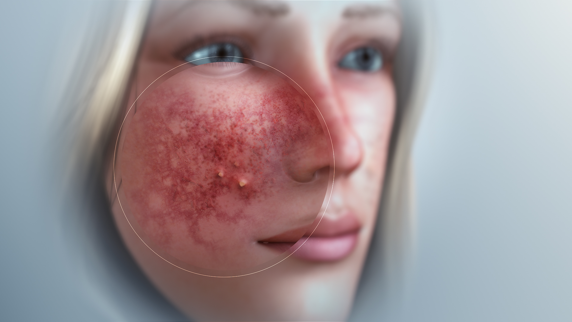 3D Medical Animation still of Rosacea infected face