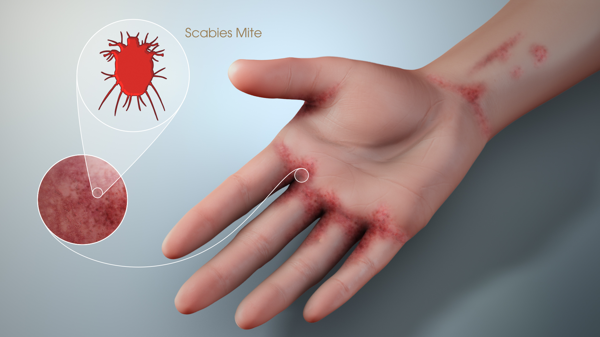 3D Medical Animation still showing Scabies mites reproducing on the surface of the skin