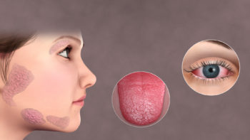 Characteristic sicca or "dryness" appears at multiple locations like the tongue, face or eyes (keratoconjunctivitis)