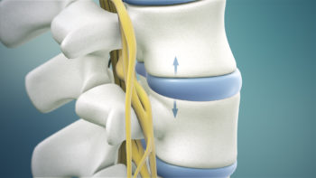 Spinal decompression is a surgical procedure that reduces pressure on the spinal cord.