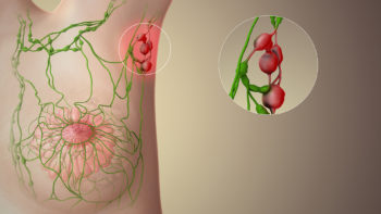 A still from a 3D medical animation showing enlarged Lymph nodes.