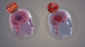 Two types of stroke: Ischemic (L) and Hemorrhagic (R)