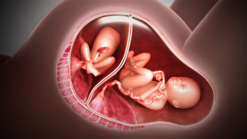A still from a 3D medical animation showing an acardiac twin.