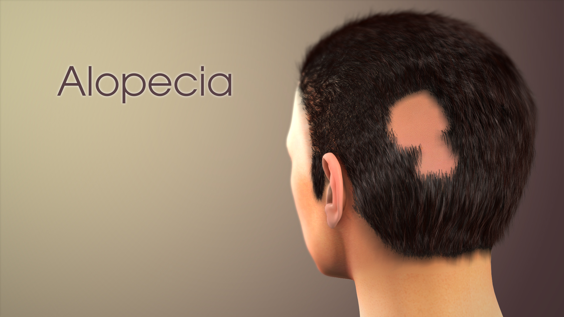 3D medical animation still showing Alopecia