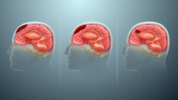 L to R: Epidural Hematoma, Subdural Hematoma, and Intracranial Hematoma.