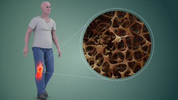 Reduced bone mineral density in Osteoporosis