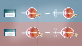 (Top to bottom)Hyperopia vision or farsightedness (corrected using Convex lens) and Myopia vision or nearsightedness (corrected using Concave lens).