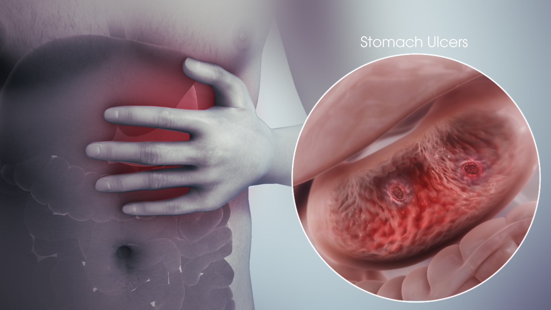 3D Medical Animation still showing Stomach Ulcer