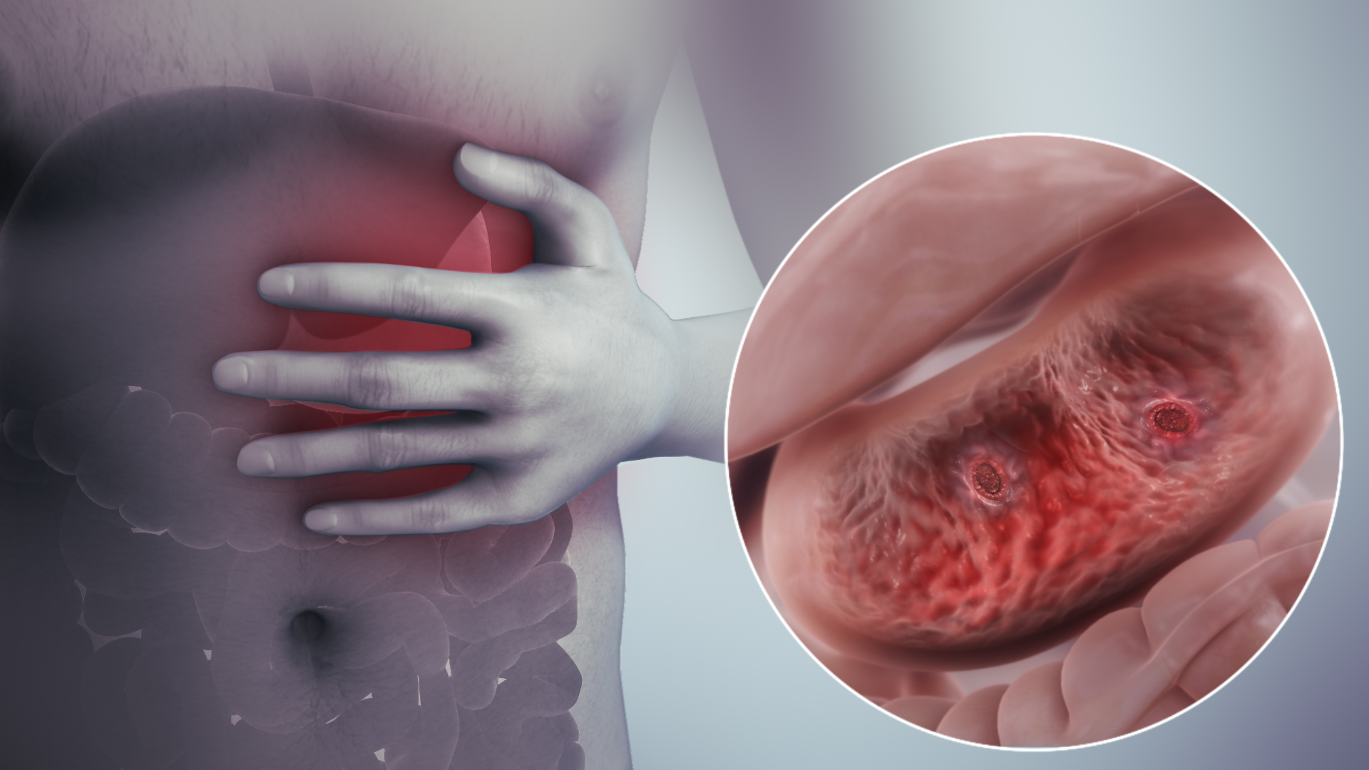 Various reasons for Stomach Ulcer - Scientific Animations
