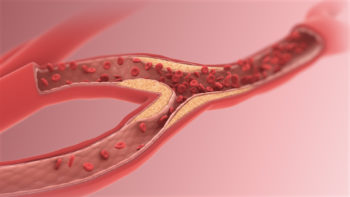 Decreased diameter of Arteriole.