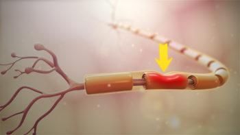 3D Medical Animation still showing Neurapraxia compression of the nerve