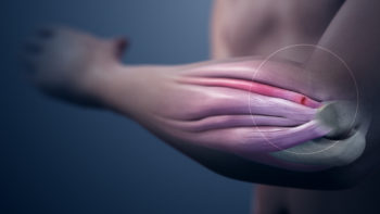 3D Medical Animation still showing inflammed tendons of the hand.